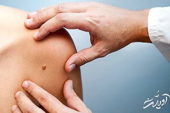 خال روی شانه